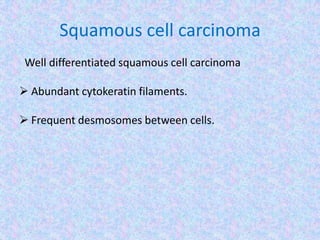 Squamous cell carcinoma
 Well differentiated squamous cell carcinoma

 Abundant cytokeratin filaments.

 Frequent desmosomes between cells.
 