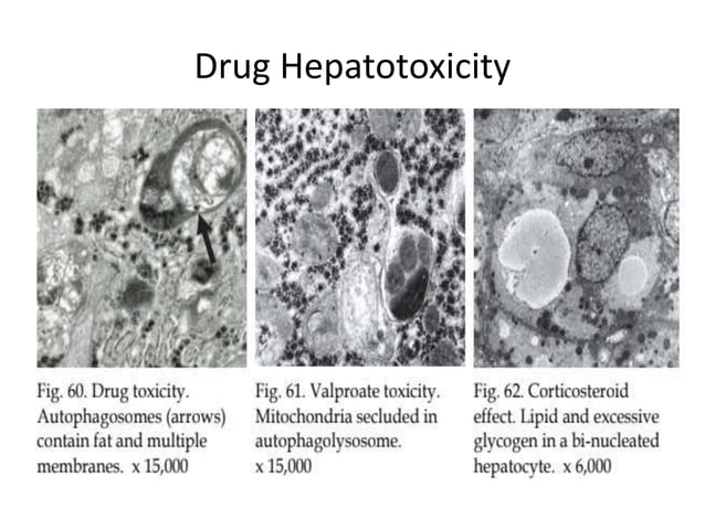 Electron microscopy of liver diseases- 2020 | PPTX | Blood Disorders ...