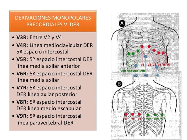 V4r Ekg 12 Lead ECG Placement The Different Versions V4r Ekg 12 Lead ECG Placement The Different Versions