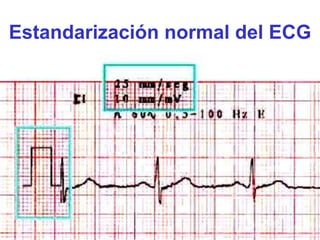 Estandarización normal del ECG
 
