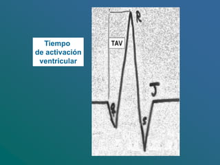 Tiempo
de activación
ventricular
 
