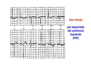 Alto Voltaje
por hipertrofia
del ventrículo
izquierdo
(HVI)
 