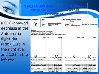 A Case of Adult-Onset Vitelliform Dystrophy
Treated with Intravitreal Injection of
Bevacizumab
((EOG) showed
decrease in the
Arden ratio
(light-dark
ratio), 1.16 in
the right eye
and 1.25 in the
left eye.
 