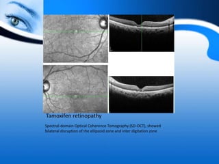 Tamoxifen retinopathy
Spectral-domain Optical Coherence Tomography (SD-OCT), showed
bilateral disruption of the ellipsoid zone and inter digitation zone
 