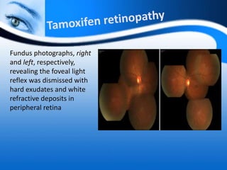 Fundus photographs, right
and left, respectively,
revealing the foveal light
reflex was dismissed with
hard exudates and white
refractive deposits in
peripheral retina
 