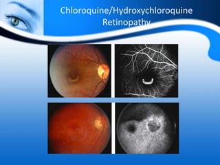 Chloroquine/Hydroxychloroquine
Retinopathy
 