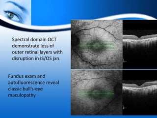 Spectral domain OCT
demonstrate loss of
outer retinal layers with
disruption in IS/OS jxn.
Fundus exam and
autofluorescence reveal
classic bull’s-eye
maculopathy
 