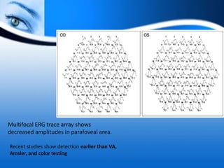 Multifocal ERG trace array shows
decreased amplitudes in parafoveal area.
Recent studies show detection earlier than VA,
Amsler, and color testing
 