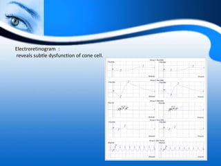 Electroretinogram :
reveals subtle dysfunction of cone cell.
 