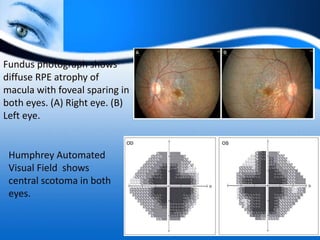 Fundus photograph shows
diffuse RPE atrophy of
macula with foveal sparing in
both eyes. (A) Right eye. (B)
Left eye.
Humphrey Automated
Visual Field shows
central scotoma in both
eyes.
 