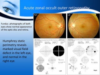 Acute zonal occult outer retinopathy
Fundus photographs of both
eyes show normal appearance
of the optic disc and retina.
Humphrey static
perimetry reveals
marked visual field
defect in the left eye,
and normal in the
right eye.
 