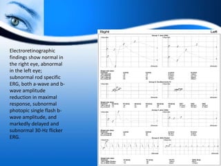 Electroretinographic
findings show normal in
the right eye, abnormal
in the left eye;
subnormal rod specific
ERG, both a-wave and b-
wave amplitude
reduction in maximal
response, subnormal
photopic single flash b-
wave amplitude, and
markedly delayed and
subnormal 30-Hz flicker
ERG.
 