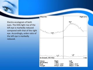 Electro-oculogram of both
eyes. The EOG light rise of the
left eye is markedly reduced
compared with that of the right
eye. Accordingly, arden ratio of
the left eye is markedly
reduced.
 