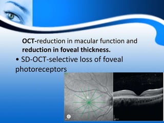 OCT-reduction in macular function and
reduction in foveal thickness.
• SD-OCT-selective loss of foveal
photoreceptors
 
