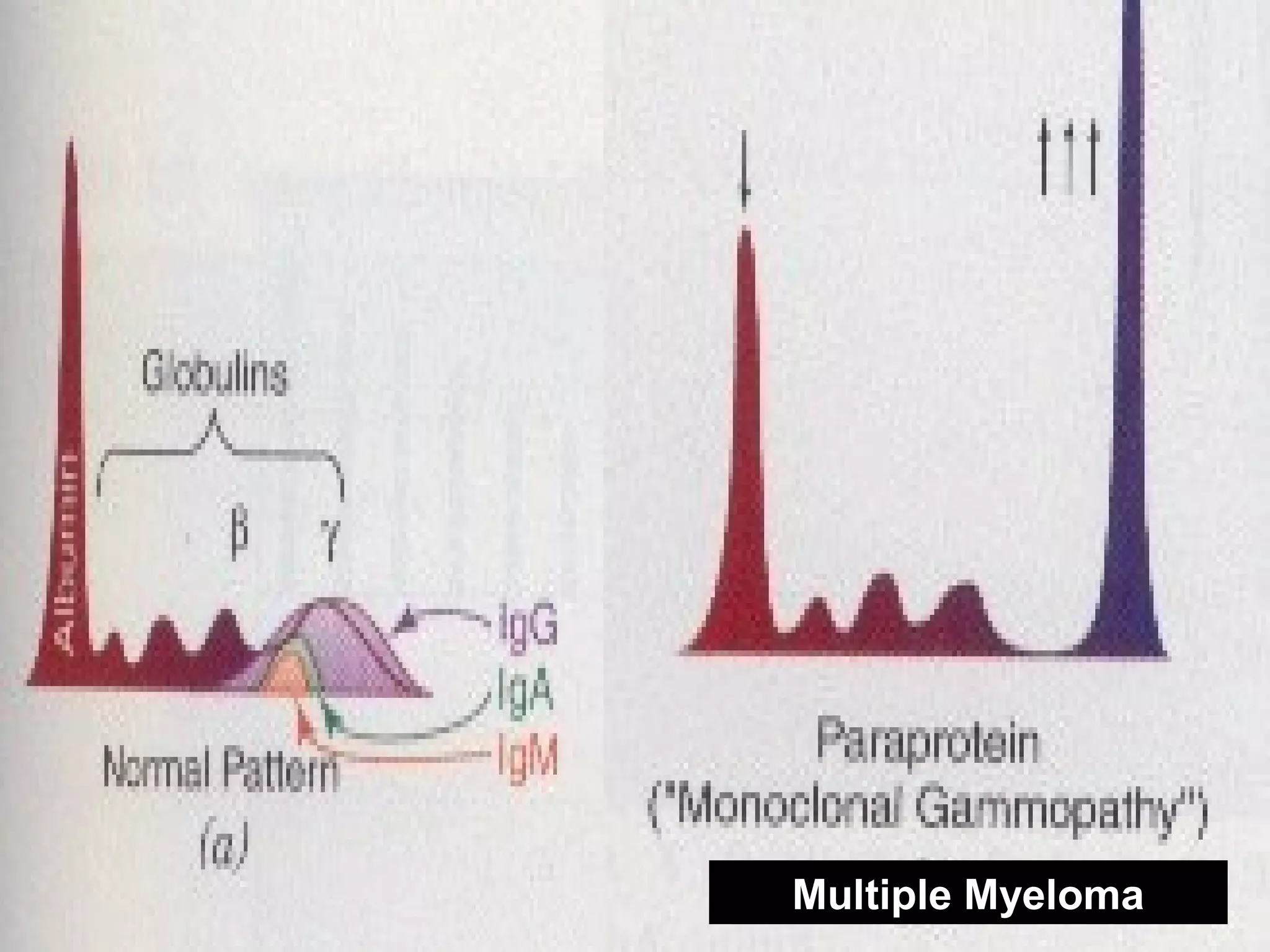 Multiple Myeloma
 