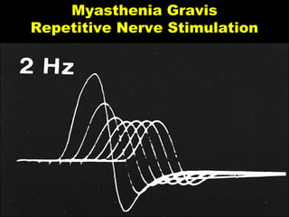 Electrophysiological Assessment Of Neuromuscular Transmission PPT