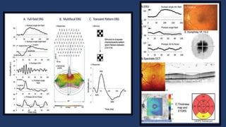 Electrophysiology (Electro-retinogram,Electro-oculogram, Visual evoked ...