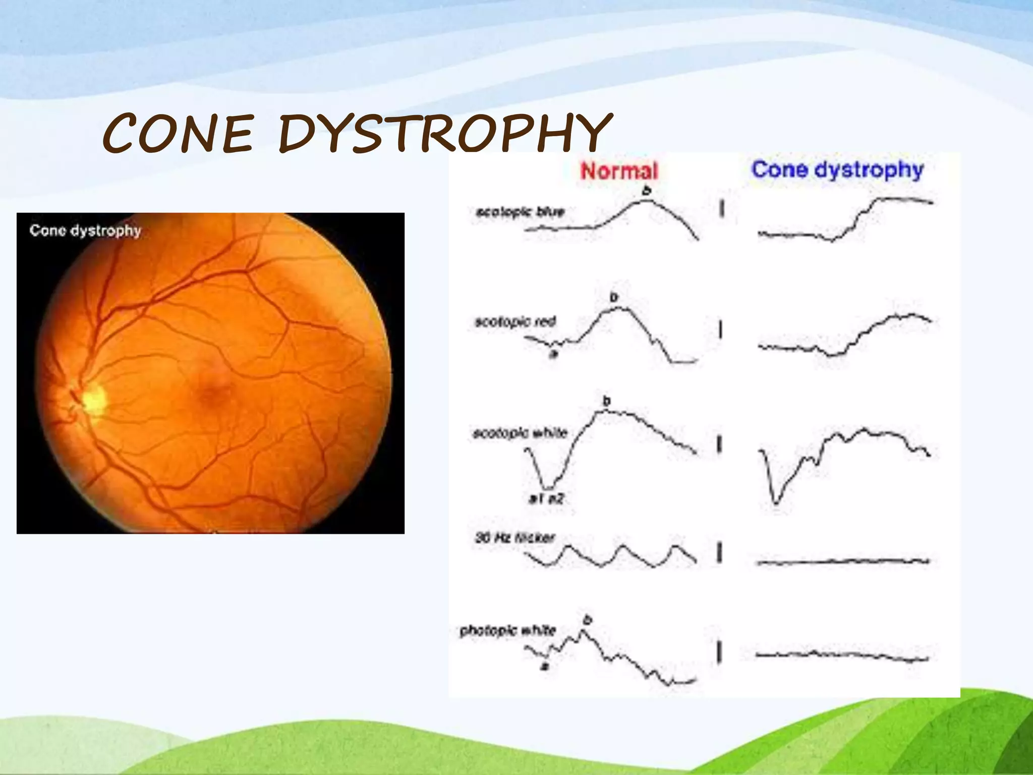 CONE DYSTROPHY
 