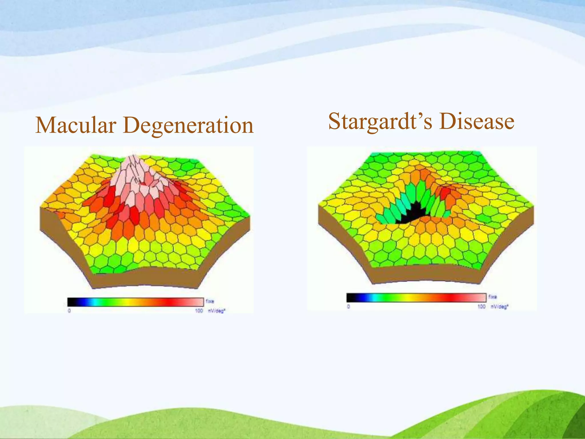 Macular Degeneration Stargardt’s Disease
 