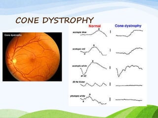 CONE DYSTROPHY
 