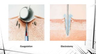 Coagulation Electrotomy
 