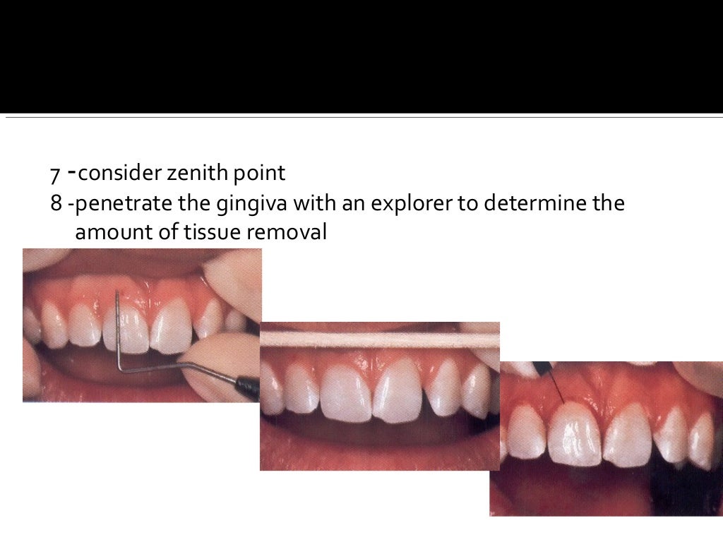 Electro surgery in dental practice