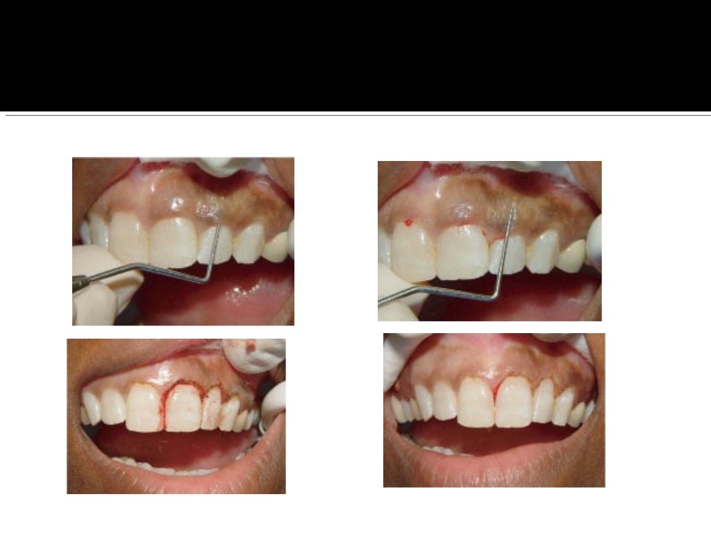 Electro surgery in dental practice