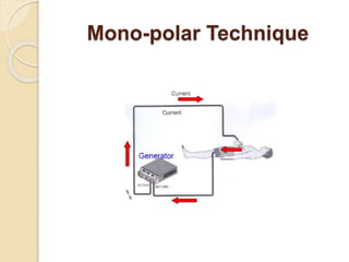 Mono-polar Technique 
 