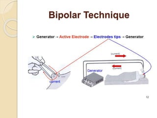 Bipolar Technique 
 