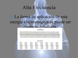 Alta Frecuencia
La forma de aplicación de esta
energía electromagnética puede ser
continua o pulsada.
 
