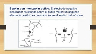 Bipolar con monopolar activo: El electrodo negativo
localizador es situado sobre el punto motor; un segundo
electrodo positivo es colocado sobre el tendón del músculo
 