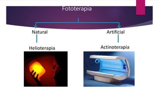 Fototerapia
Natural Artificial
Helioterapia Actinoterapia
 