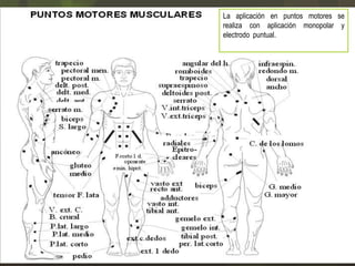 La aplicación en puntos motores se
realiza con aplicación monopolar y
electrodo puntual.

 