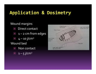 Wound margins
Direct contact
1 – 2 cm from edges
4 – 10 j/cm2
Wound bed
Non contact
1 – 5 j/cm2
 