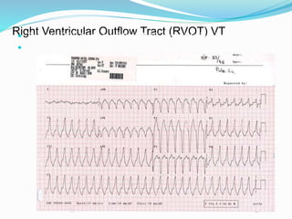 Normal Rvot Cw ELEKTROKARDIOGRAFI.pptx