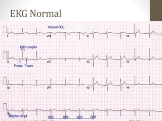 EKG Normal
 
