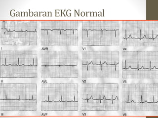 Gambaran EKG Normal
 