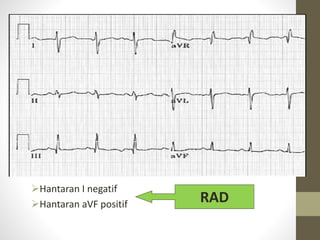 Hantaran I negatif
Hantaran aVF positif RAD
 