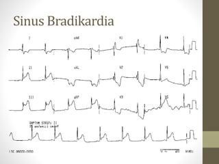 Sinus Bradikardia
 