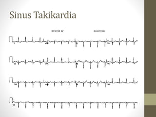 Sinus Takikardia
 