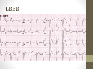 LBBB
 