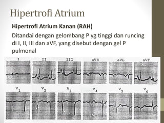 Hipertrofi Atrium
Hipertrofi Atrium Kanan (RAH)
Ditandai dengan gelombang P yg tinggi dan runcing
di I, II, III dan aVF, yang disebut dengan gel P
pulmonal
 