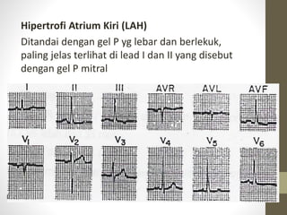 Hipertrofi Atrium Kiri (LAH)
Ditandai dengan gel P yg lebar dan berlekuk,
paling jelas terlihat di lead I dan II yang disebut
dengan gel P mitral
 