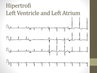 Hipertrofi
Left Ventricle and Left Atrium
 