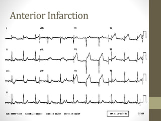 Anterior Infarction
 