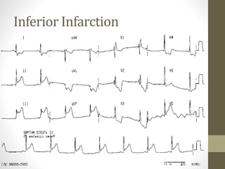 Inferior Infarction
 
