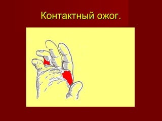 Контактный ожог.Контактный ожог.
 