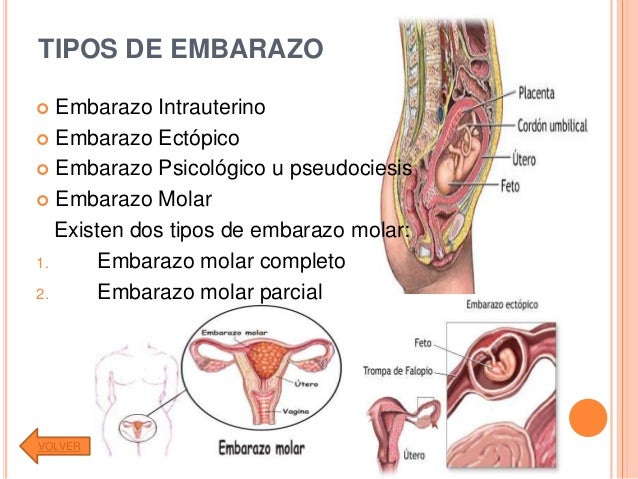 Image result for tipos de embarazo