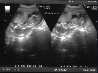 17 semanas
 