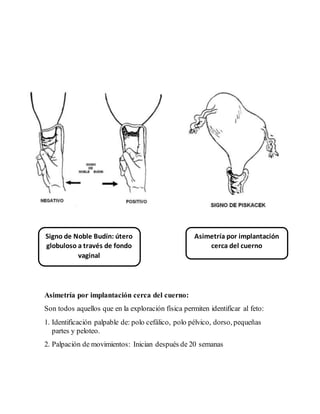 Asimetría por implantación cerca del cuerno:
Son todos aquellos que en la exploración física permiten identificar al feto:
1. Identificación palpable de: polo cefálico, polo pélvico, dorso, pequeñas
partes y peloteo.
2. Palpación de movimientos: Inician después de 20 semanas
Asimetría por implantación
cerca del cuerno
Signo de Noble Budín: útero
globuloso a través de fondo
vaginal
 